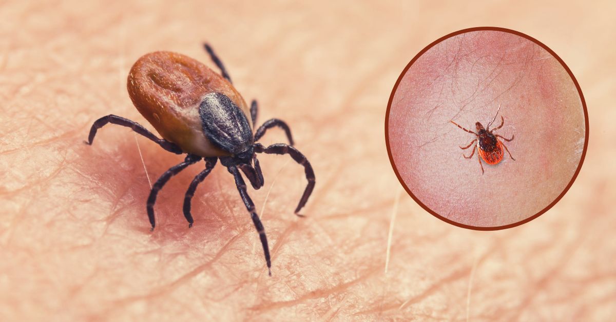 Tick Borne Disease 