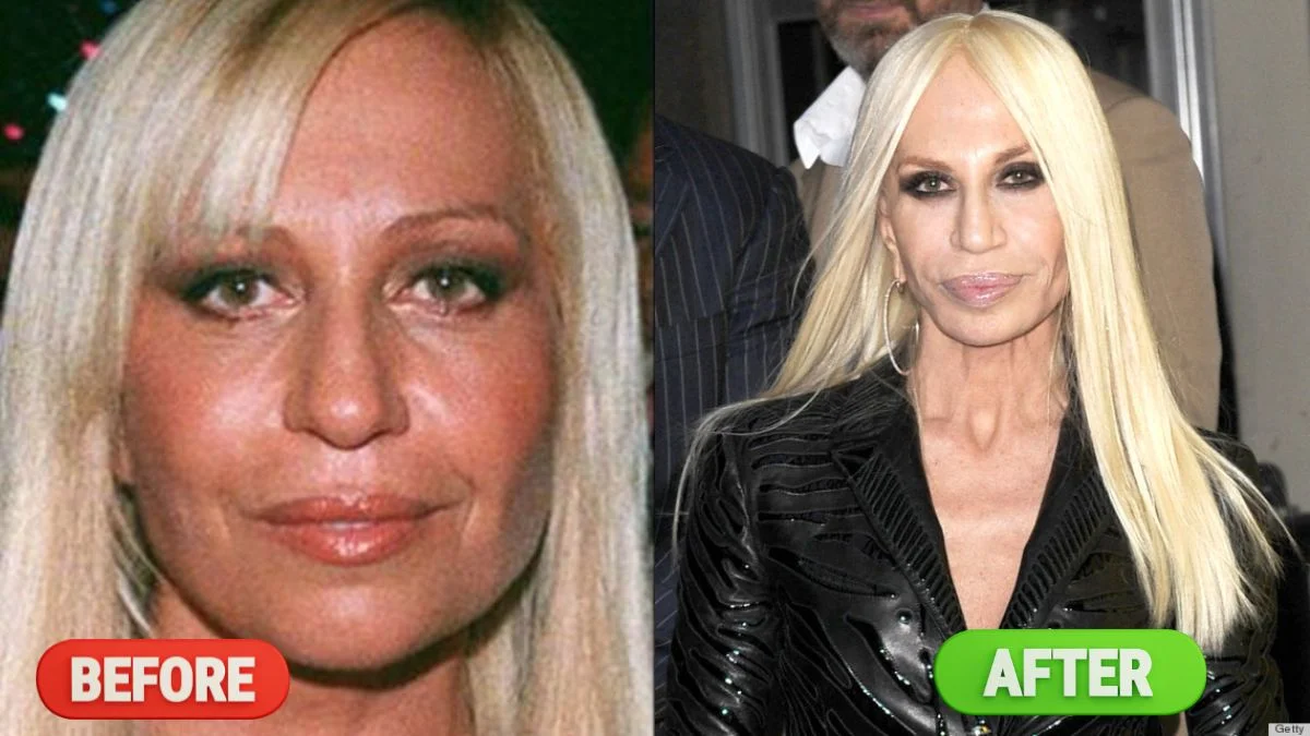 Donatella Versace Before and After Surgery