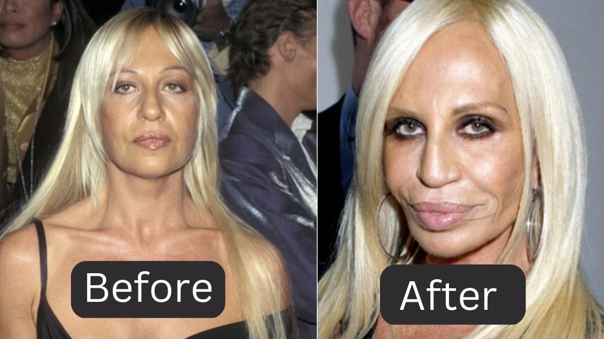 Donatella Versace Before and After of Nose Surgery 