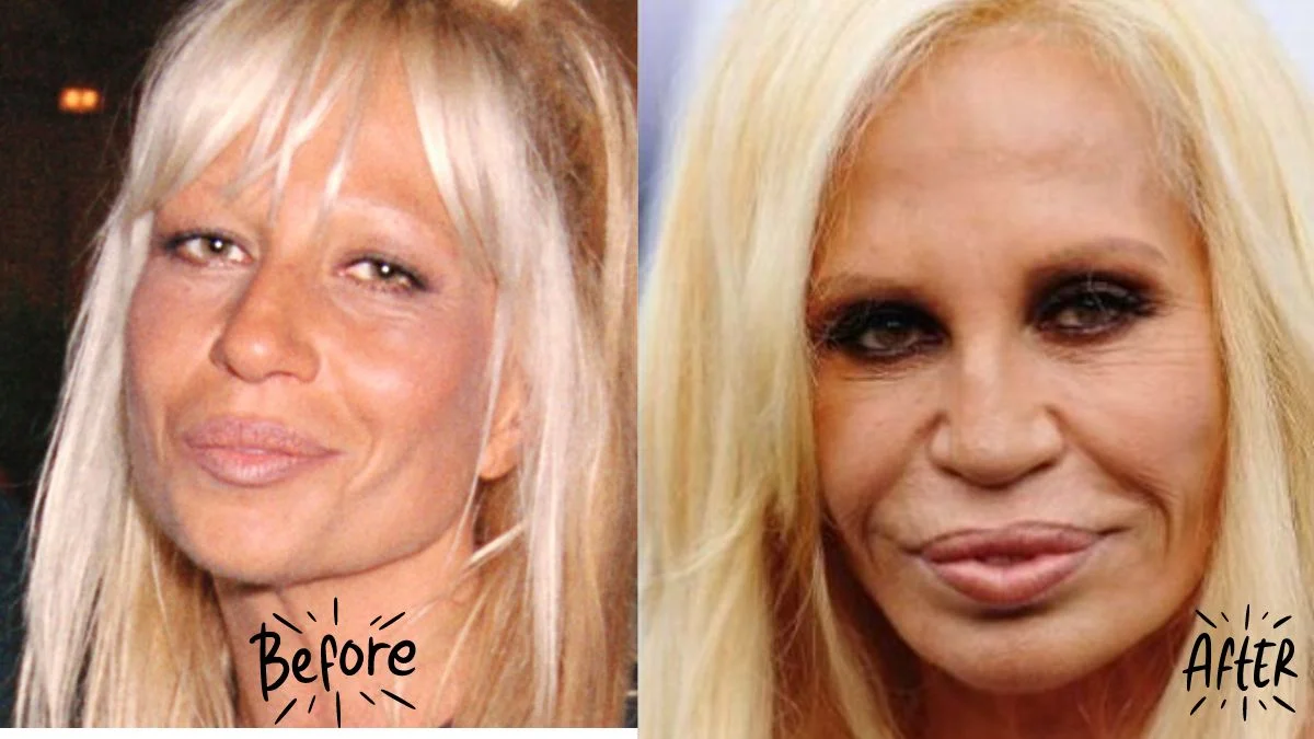 Donatella Versace's Eyelids Surgery