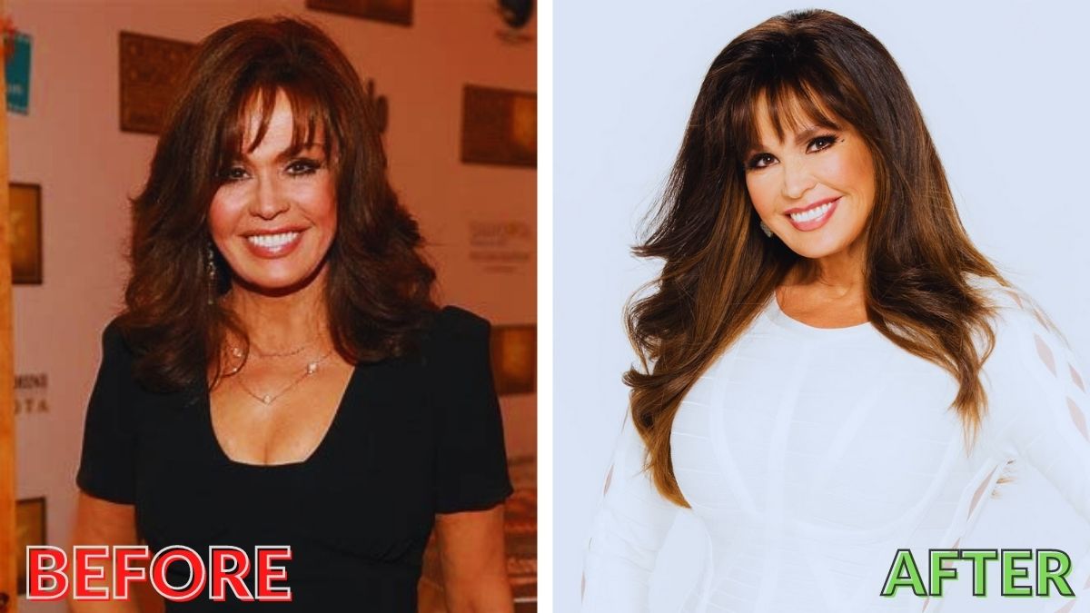 Marie Osmond Plastic Surgery 