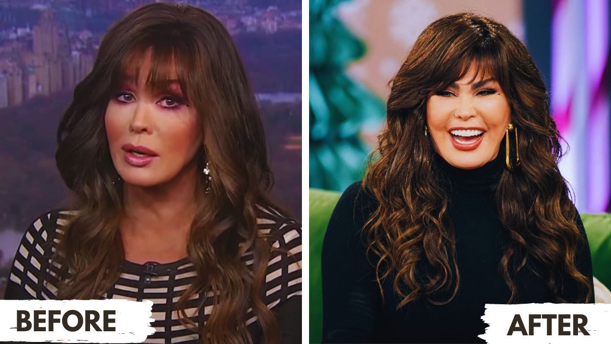 Marie Osmond Plastic Surgery