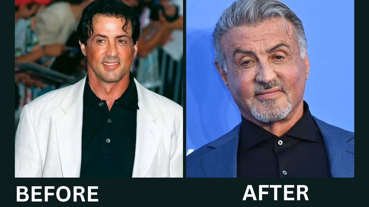 Sylvester Stallone Plastic Surgery